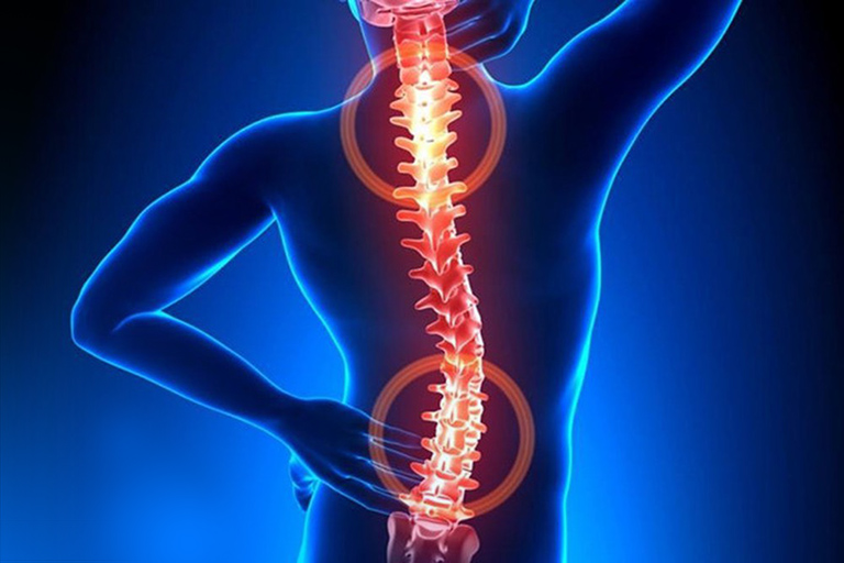 Dấu hiệu thoát vị đĩa đệm: Ban đầu cơn đau sẽ xuất hiện ở vị trí thoát vị, chủ yếu là thắt lưng và cổ