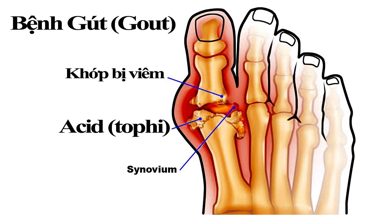 Gout hay còn gọi là thống phong, xảy ra khi axit uric trong máu tăng vượt quá mức quy định