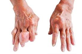 dấu hiệu của bệnh gout phát hiện sớm bệnh - Các khớp xương bị hành hạ gây ảnh hưởng nặng nề đến cuộc sống người bệnh