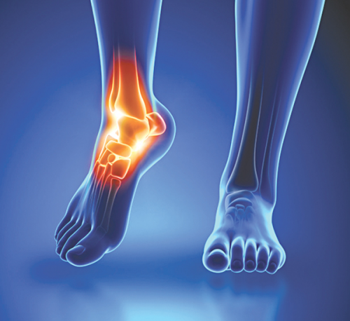 Viêm khớp cổ chân – Nguyên nhân và cách phòng ngừa