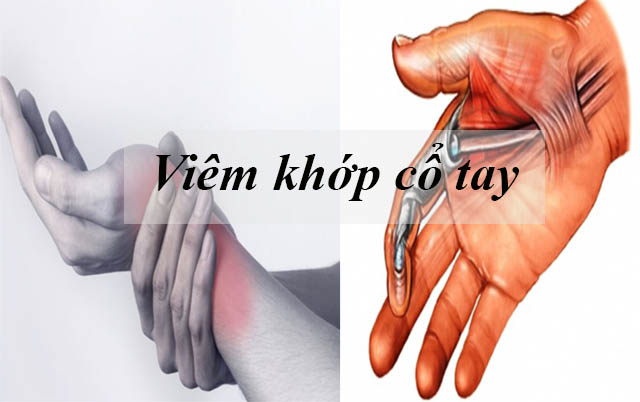 Những điều cần biết về viêm khớp cổ tay