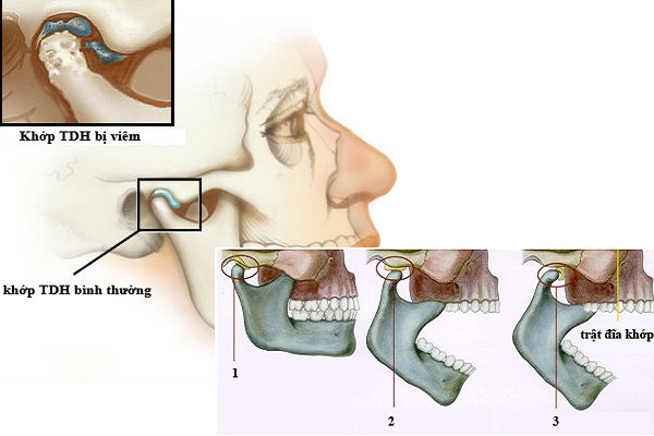 Viêm khớp thái dương hàm ảnh hưởng lớn đến các hoạt động đóng mở miệng