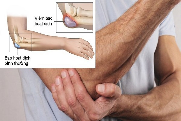 Tràn dịch khớp cổ tay - Nguyên nhân và cách điều trị